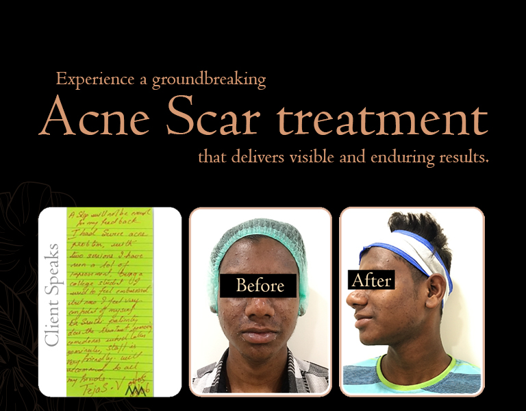 Experience a groundbreaking acne scar treatment that delivers visible and enduring results