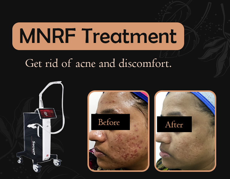 MNRF Treatment