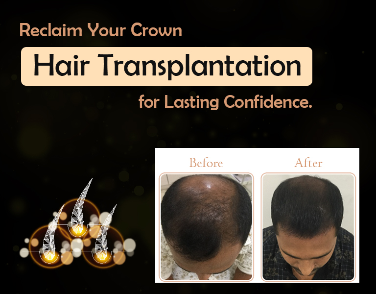 Reclaim Your Crown Hair Transplantation for Lasting Confidence